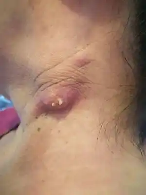 请问下大家,有没有见过这种情况:脖子上疙瘩3个月了,昨天发现突出