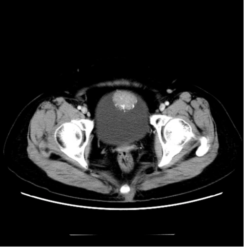 可显示肿瘤对膀胱壁浸润深度和范围,盆腔脏器与肿瘤的关系,但与ct相比
