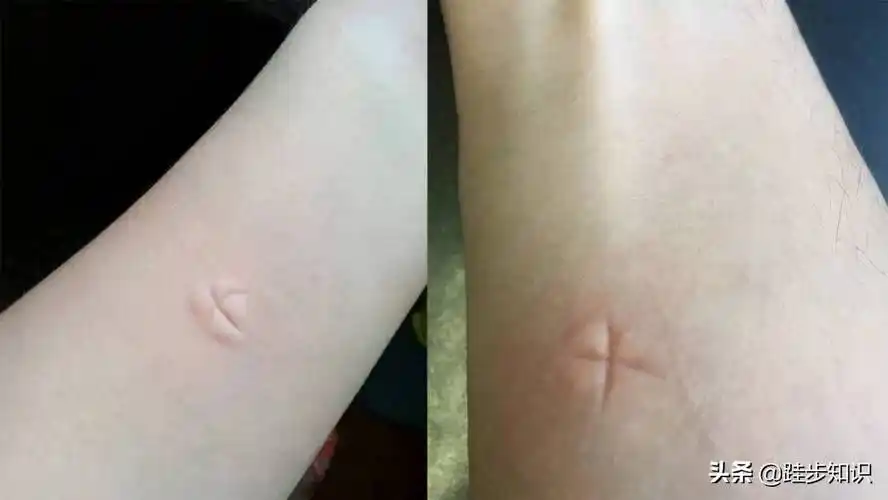 蚊子血型(蚊子喜欢咬什么血型的人?