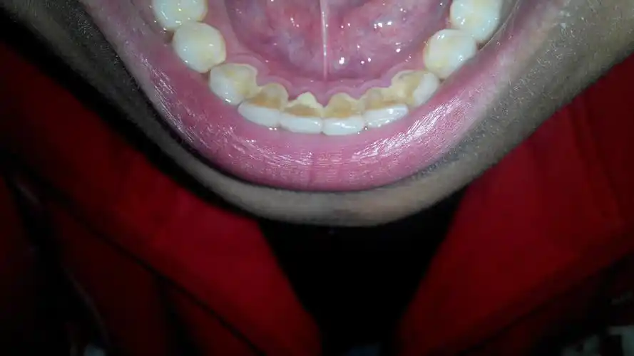 下排牙齿背面发黄表面没有前面光滑有点磨砂的感觉而且牙龈部位变