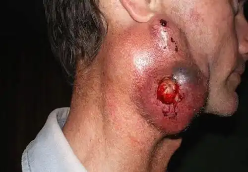 癌症症状有什么