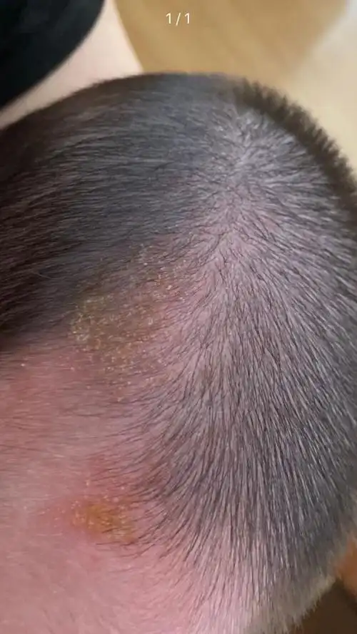 婴儿脂溢性皮炎