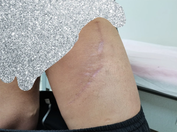 30岁男子大腿肿物疯长,脂肪肉瘤与脂肪瘤一字之差良恶性差别巨大