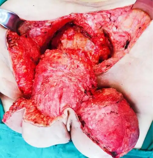 多发巨大表皮样囊肿一例,完美手术 - 微医(挂号网)