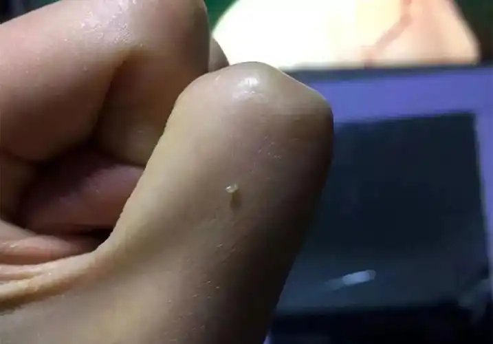 闭口和毛周角化的区别在于:闭口可以挤出淡黄色小芝麻粒大小的脂肪栓