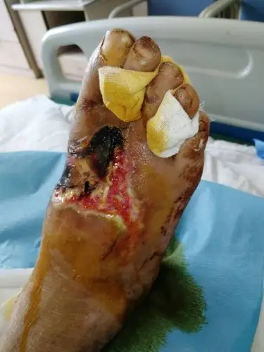 我父亲开电动车摔断脚了,脚部多处骨折,在医院上了钢板,现在上钢板的