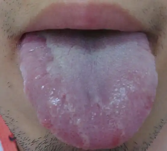 舌头两侧溃疡严重.