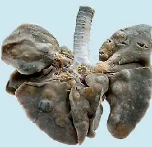 肺吸虫病有什么表现