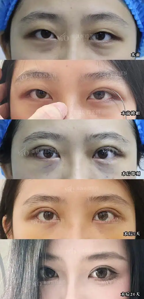 全切双眼皮恢复期记录,0-20天消肿变化    下垂眼型做上扬型平扇双