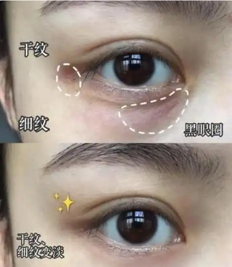 众所周知,衰老都是从眼角开始,当眼周出现干纹,细纹,眼袋,黑眼圈等