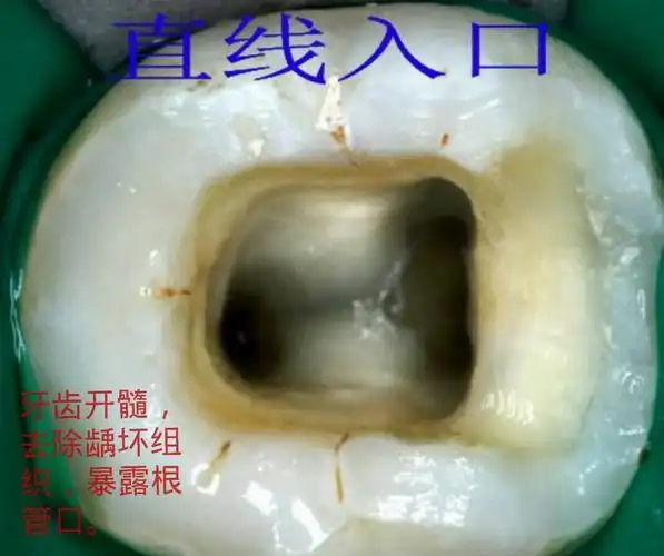 开髓.也就是用牙钻去除牙面的龋坏组织,暴露根管.