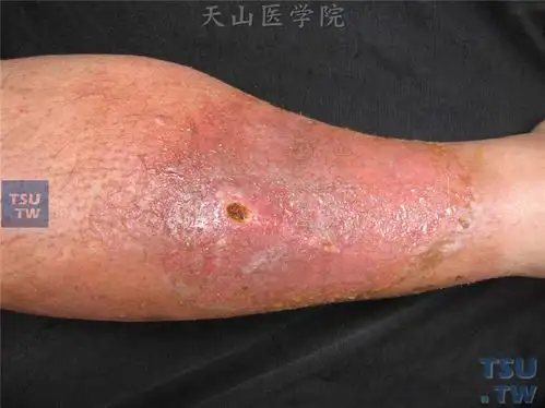 传染性湿疹样皮炎的症状表现