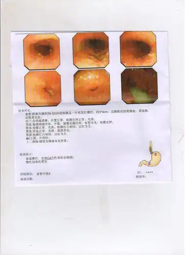 活检报告等待中,急需求专家解答,问题:从胃镜图片及文字上看会不会是