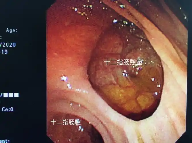 什么是十二指肠憩室