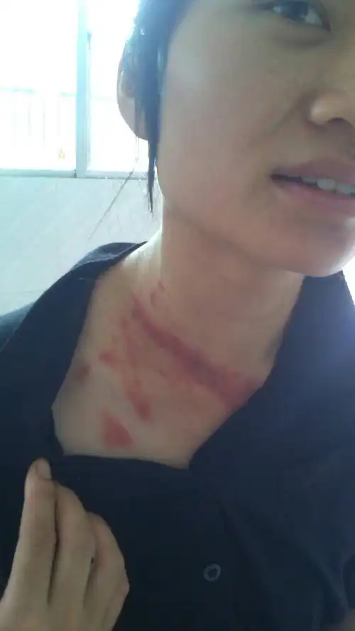 问:就在家没出去,起床就有这些红斑,不痒不痛,不知