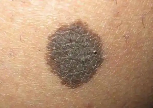 你家有没有_皮肤_被视为_黑色素