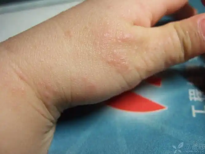 【原创】2岁5个月小儿,手背皮疹一周,见图