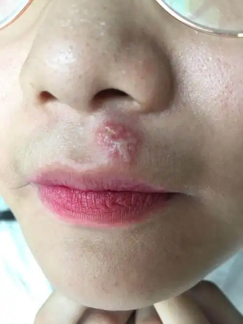 典型皮损:1,带疱,2,玫瑰糠疹,3,真菌癣,4,单纯性疱疹.