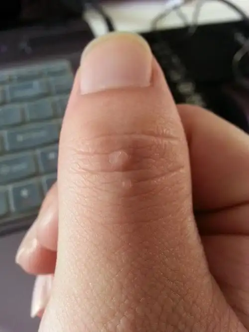 谁能告诉我手指上的肉疙瘩是什么病,怎么治?