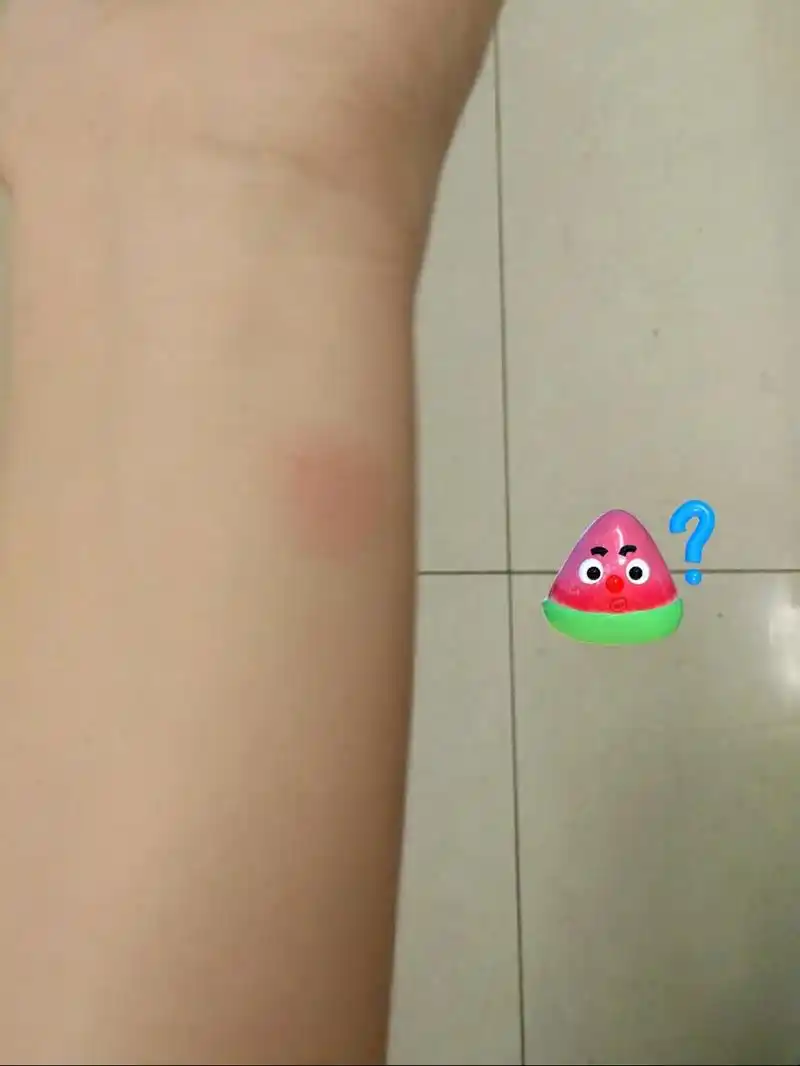 做肺结核皮试已经快30小时了,这个样子正常吗?