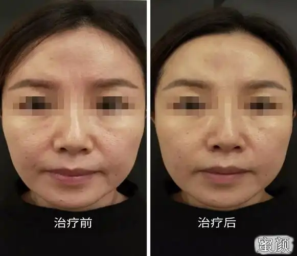 面部紧致提升前后效果对比图v脸前后效果对比:纤腰前后效果对比:翘臀
