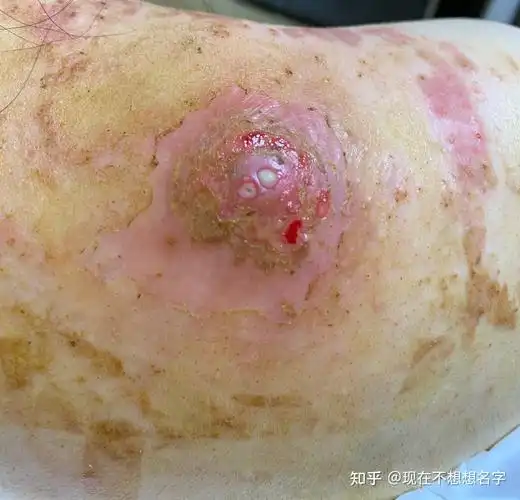 再用棉签轻轻擦掉敷上一天又会都是脓夹出来大的,镊子头太大,小的夹不