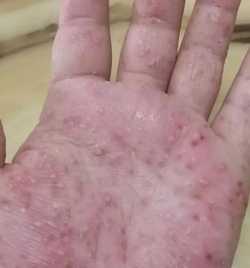 你听过掌跖脓疱病吗?