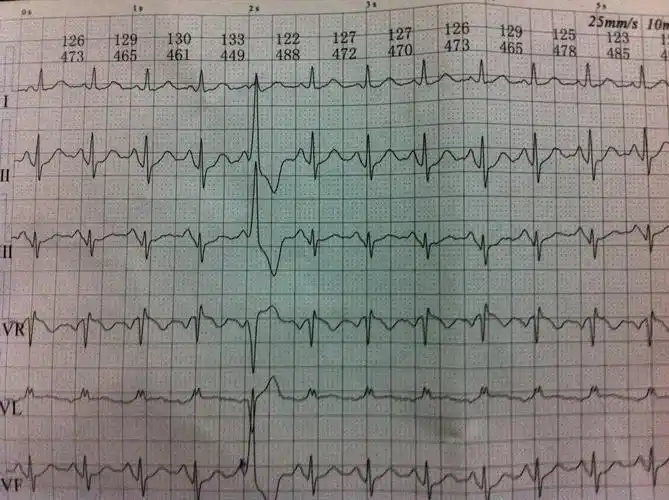 交界早? 谢谢 - 心电图脑电图专业讨论版 - 爱爱医医学论坛