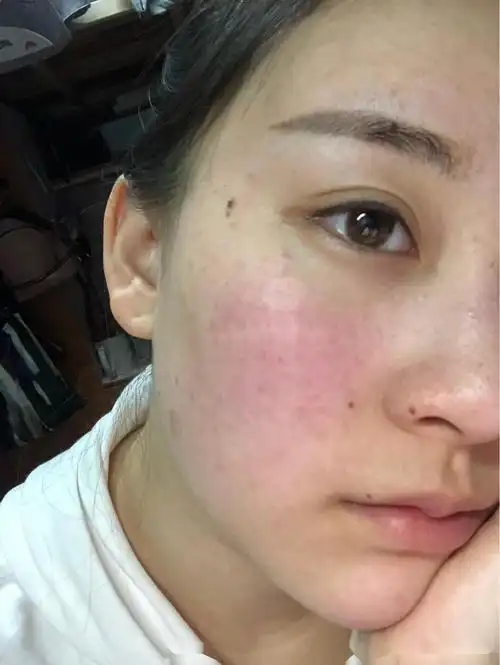 光子嫩肤案例分享:皮肤 粗糙暗沉就是会看起来更老,_圈子-新氧美容