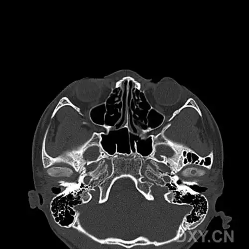【求助】鼻骨高分辨率ct解剖