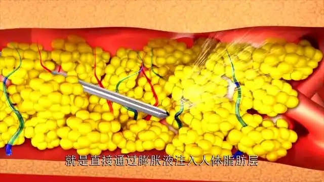 堪称最简单的减肥方法,大腿5斤脂肪瞬间被抽走!