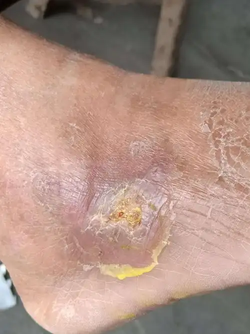 右侧脚背部近外踝处糖尿病足溃疡治疗效果展示