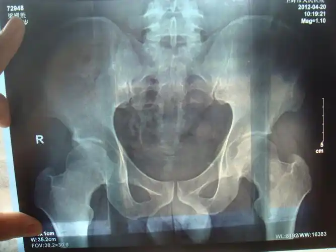 骶髂关节紊乱一例