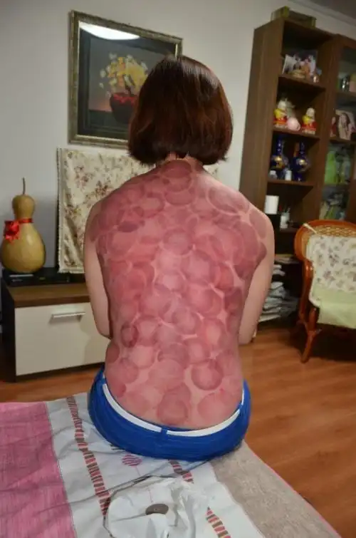 后背拔罐什么梗