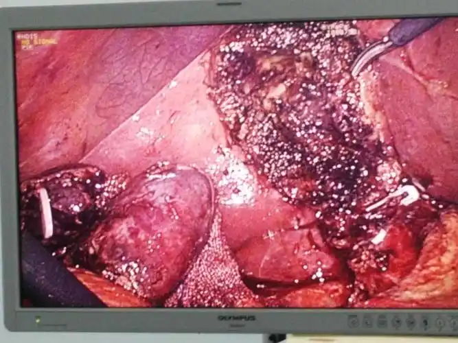 急性坏疽性胆囊炎1例.