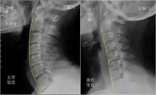 颈椎生理曲度变直其实就是颈部曲度有问题了,我们知道,颈椎正常来讲有