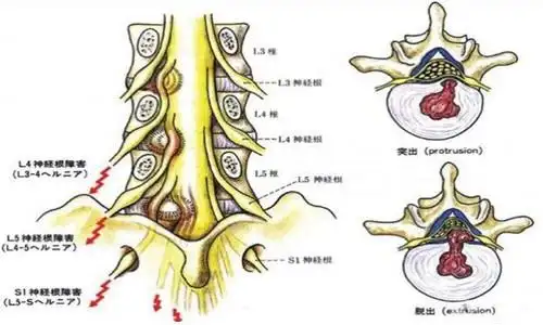 腰椎间盘突出压迫马尾神经损伤后出现的症状:下肢出现的神经系统病症