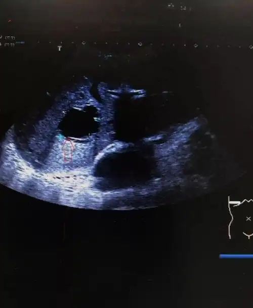 一文读懂肝囊肿的超声诊断诊断要点