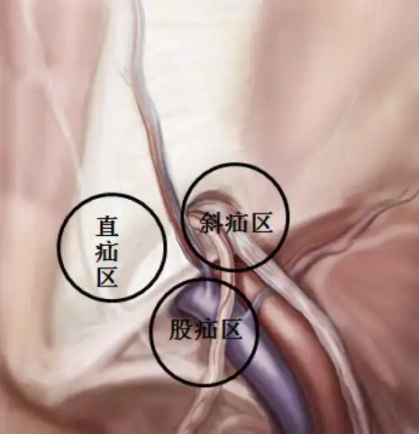 郑州市中心医院乔龙飞勿以疝小而不为之成人篇