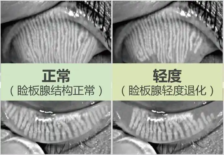 你的睑板腺还好吗?