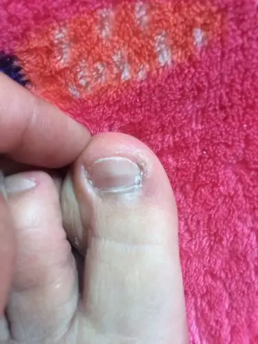 大脚趾指甲变这样了,怎么回事啊.