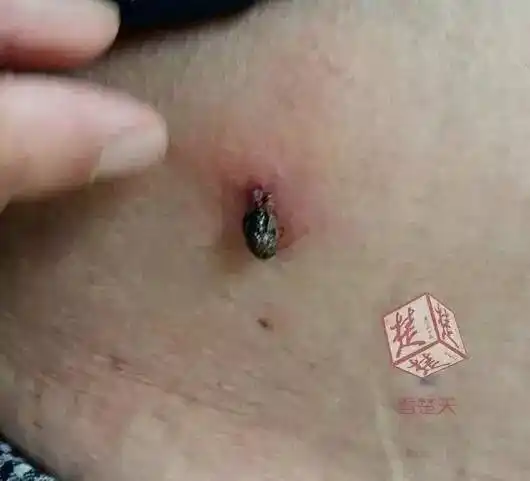 蜱虫钻进男子肚皮02烟头烫虫屁股竟无效