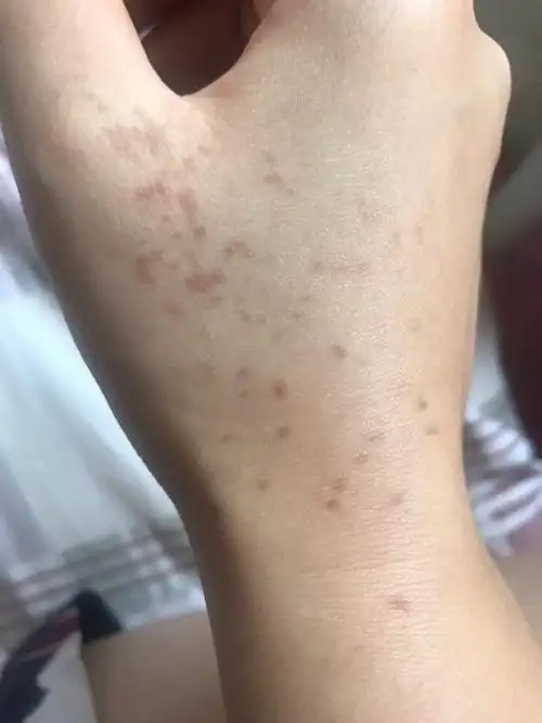 手上长斑怎么回事