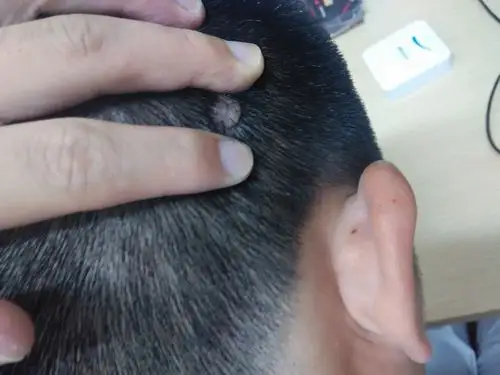 我的头皮上有个小的肉瘤,怎么办?