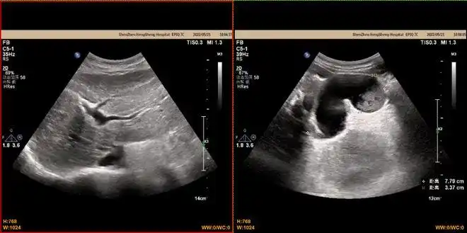 深圳一女环卫工意外车祸致脾破裂大出血,经抢救后脱离危险