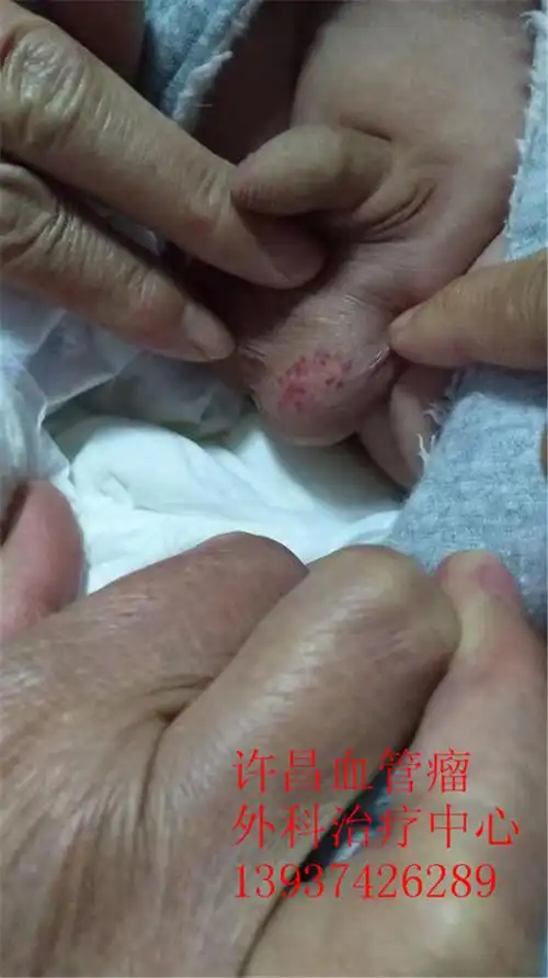 许昌治疗血管瘤,许昌五官(口腔)医院-血管瘤胎记治疗中心,草莓状血管