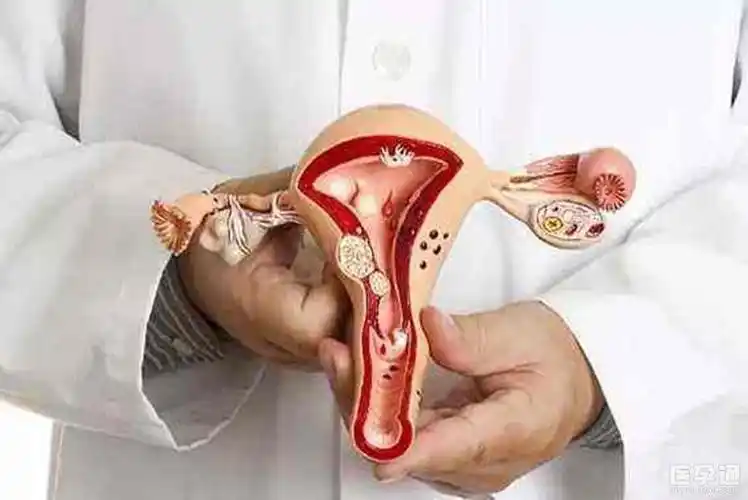女性患有盆腔积液会影响自然怀孕吗当然会好习惯让盆腔更健康