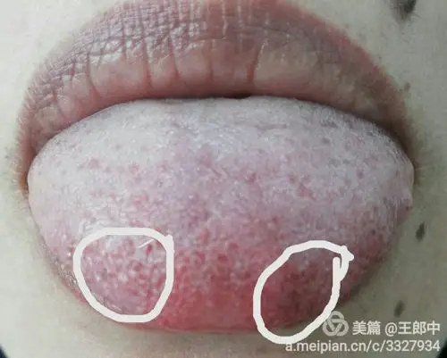 中医可以提前发现"肿瘤"