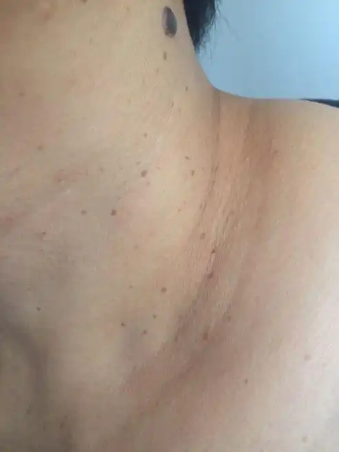 "皮赘"的病因尚不明,国外有人认为是肠息肉的一种皮肤标志,曾有人对