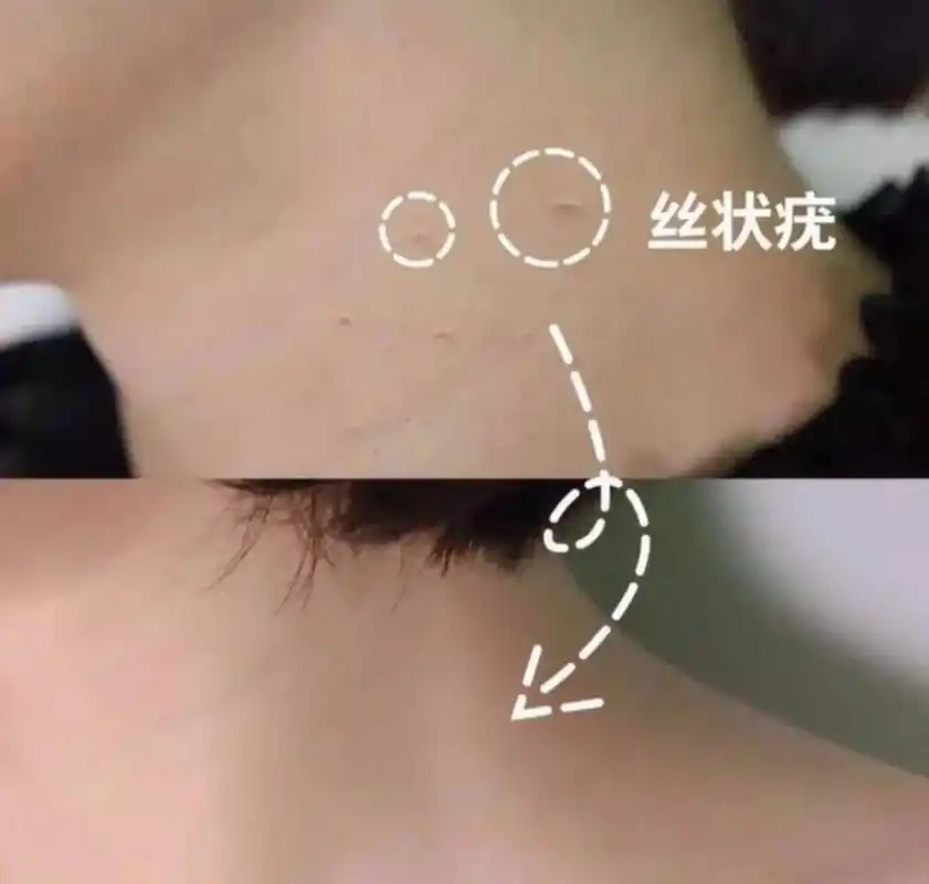 其实,它们叫【丝状疣】,  是hpv病毒感染所引起的,  顶端一般比较